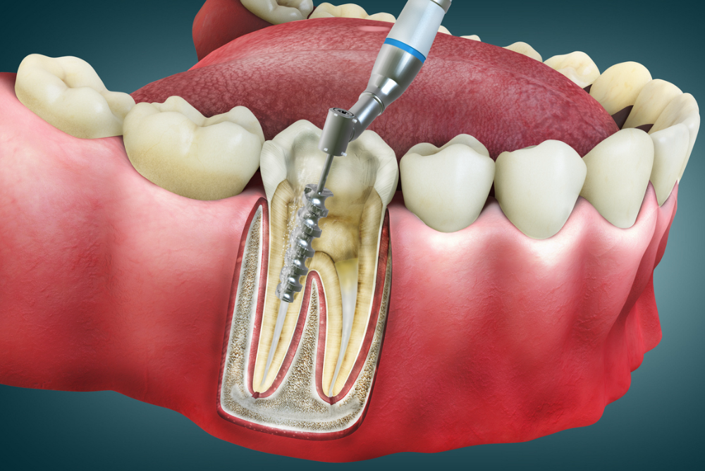 Protect your smile with expert Root Canal Therapy in Airdrie. Our dental team offers gentle and effective Root Canal Therapy Near You to relieve pain and restore oral health